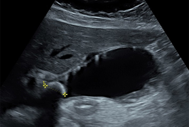 Acute Cholecystitis Acute Cholecystitis in Children