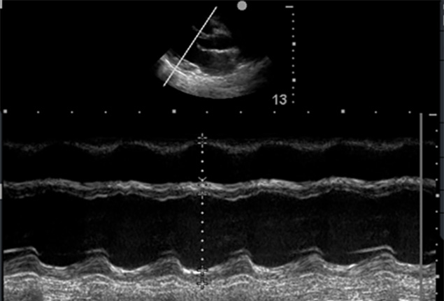 Cardiac scanning (LV M-mode) Cardiac scanning (LV M-mode)