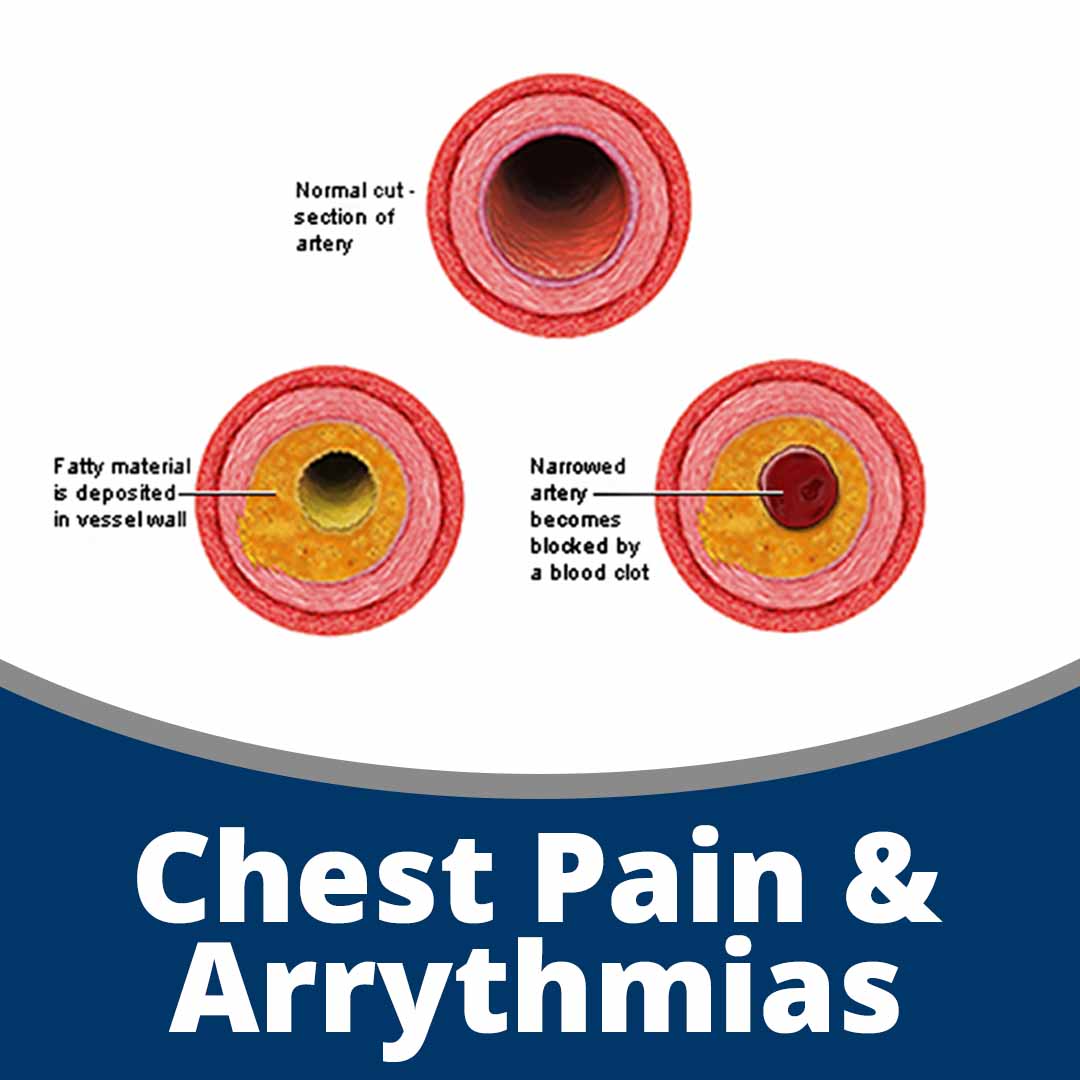chest-pain-arrythmias