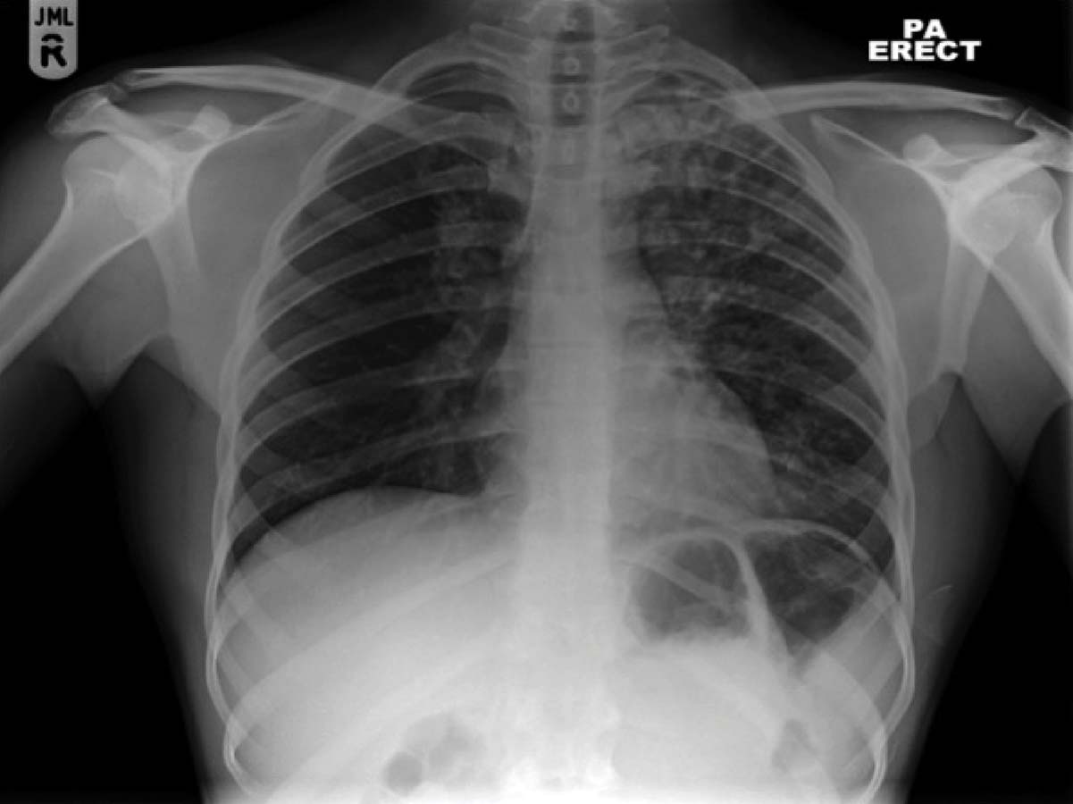 Chest X-Ray Interpretation Emergency Radiology Course (Chest X-Ray Interpretation)
