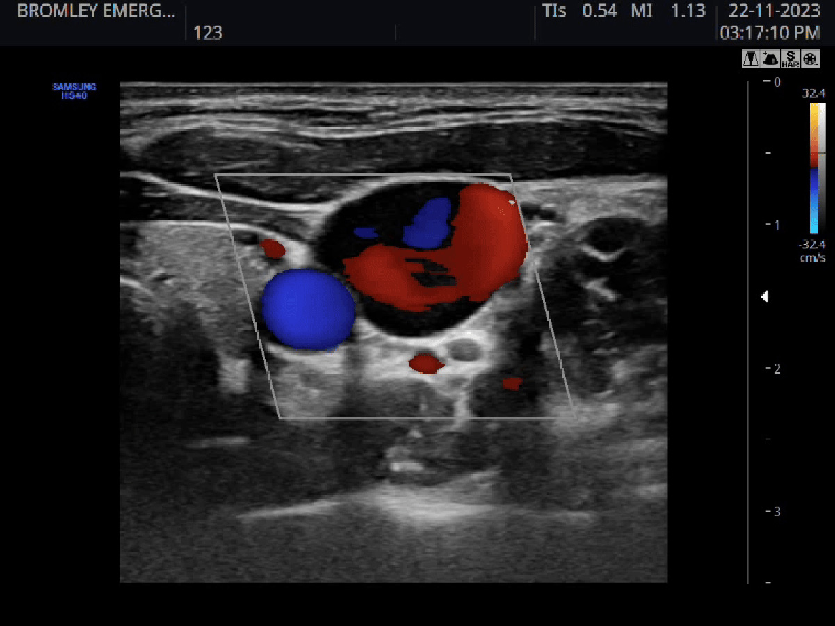 Colour Doppler – Haemodynamic assessment