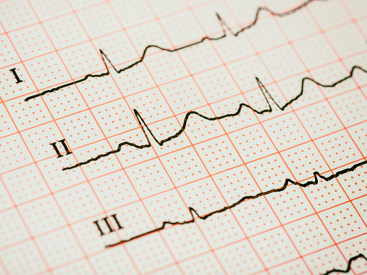 ECG Interpretation Course