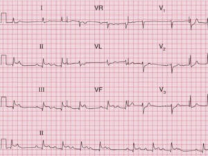 ECG reading