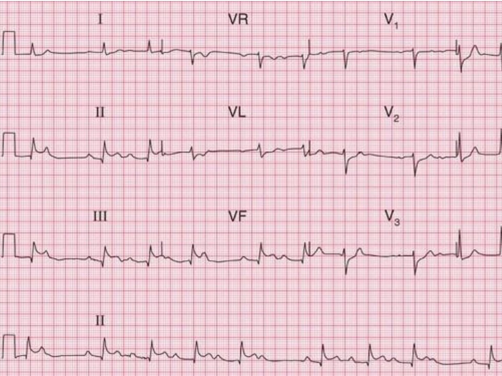 ECG reading ECG reading