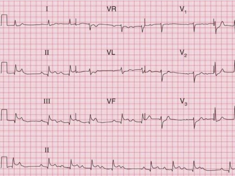 ECG reading