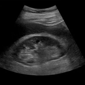 Kidney scanning