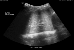 Lung Scanning (6 year old respiratory failure)