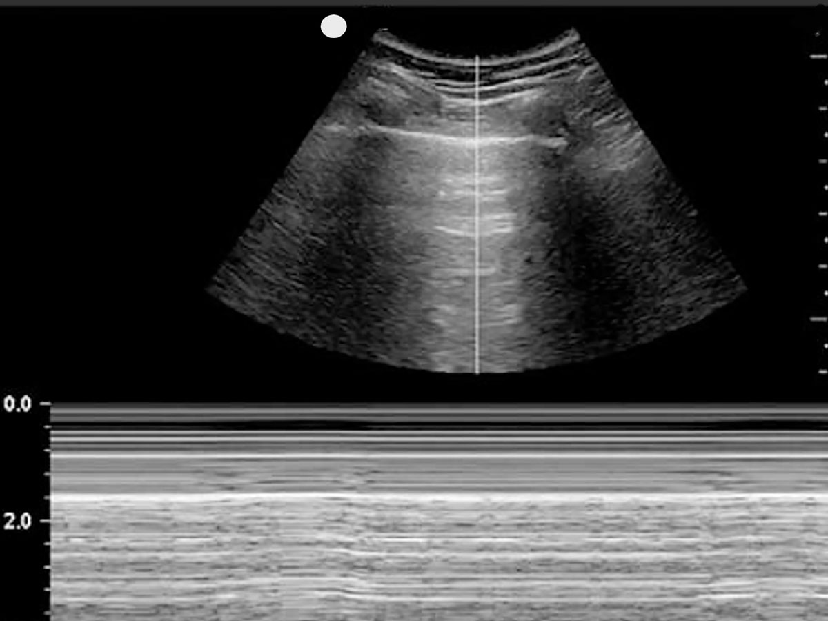 Lung Sonogram Lung Sonogram