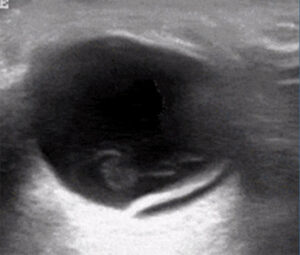 Ophtalmic POCUS Retinal Detachment