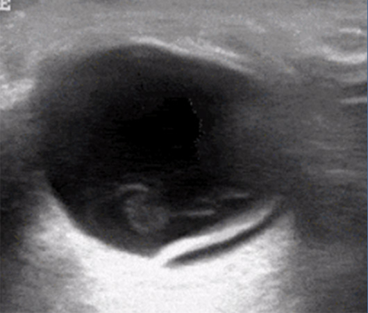 Ophthalmic POCUS Retinal Detachment