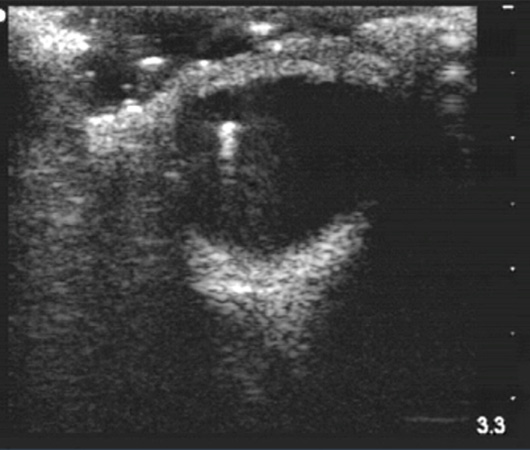 Ophthalmic PoCUS - intraocular foreign body