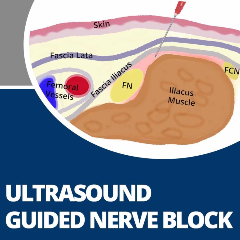 Ultrasound Guided Nerve Block