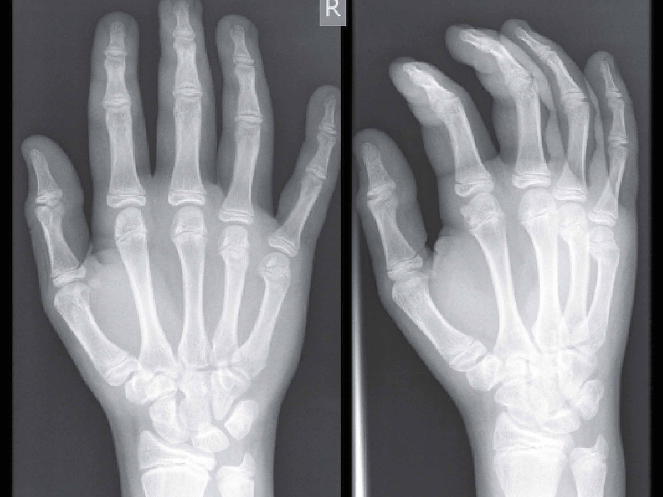 X-ray interpretation course (hands X-ray)