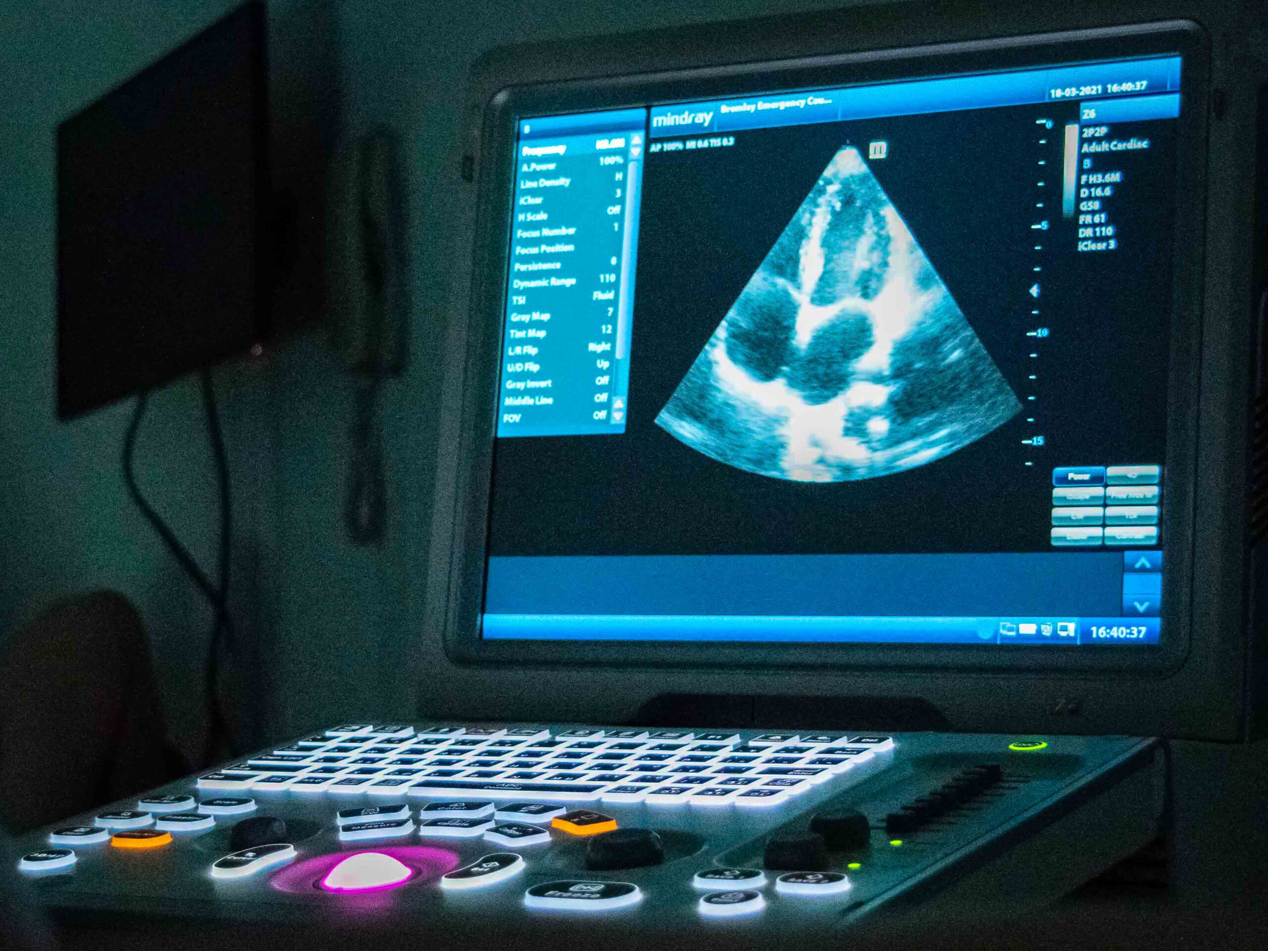 ultrasound-level-2-mindray-sonogram level-2-ultrasound